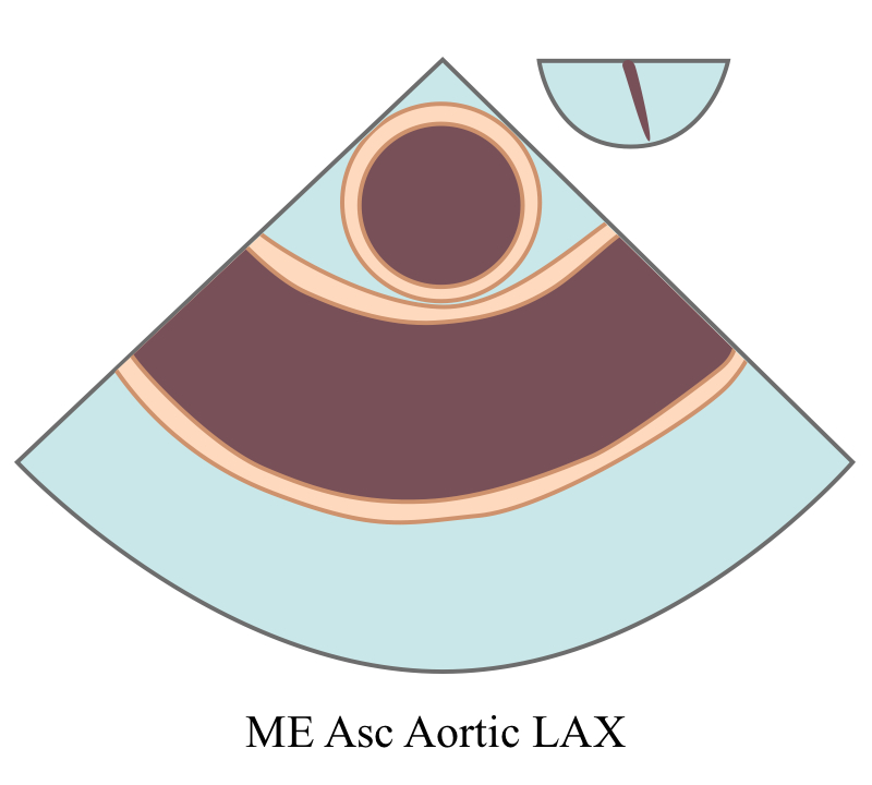 MEAscendingAorticLongAxis