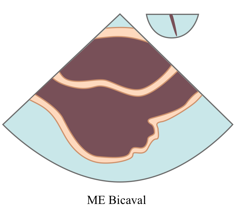 MEBicaval