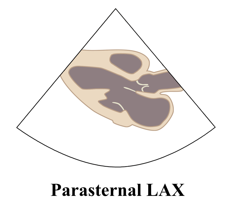 ParasternalLAXLine
