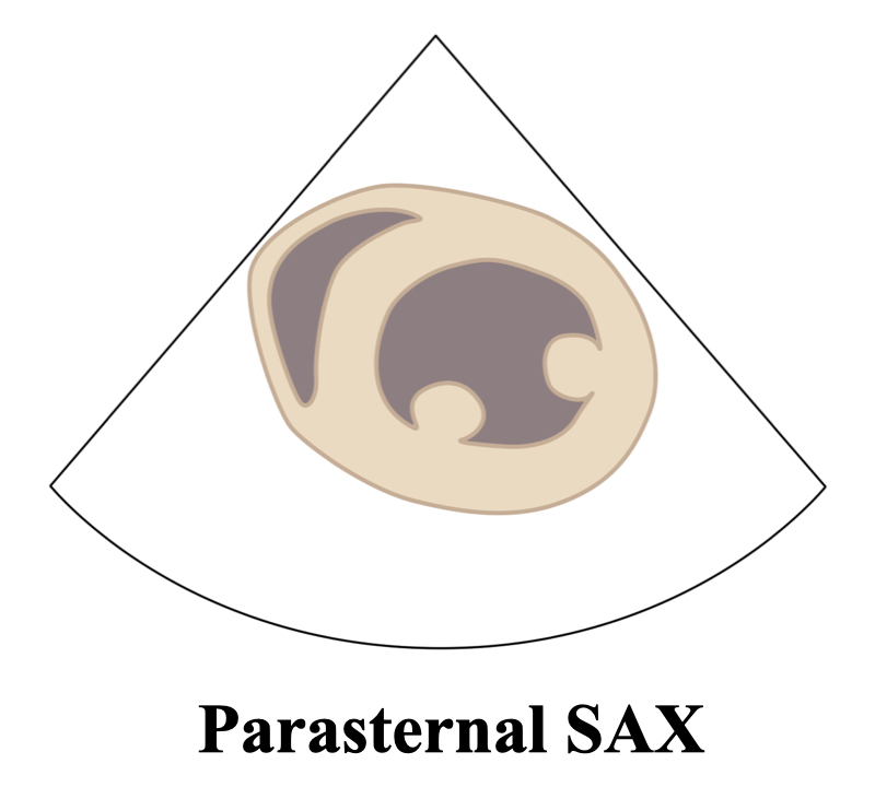 ParasternalSAXLine